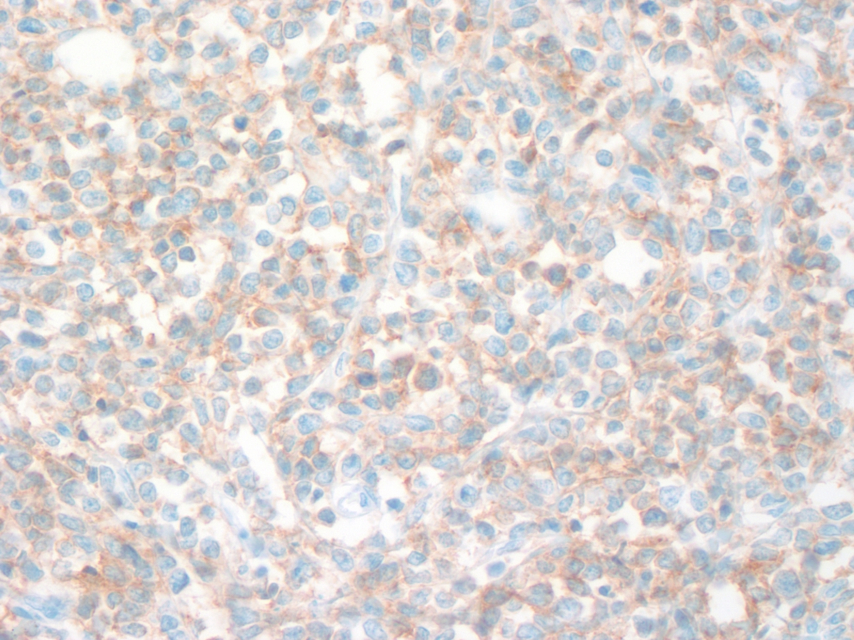 Mediastinal Mass CD56 40x